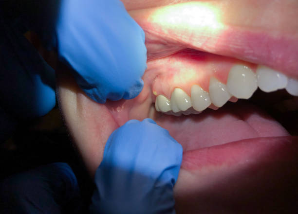 Best Root Canal Emergency Dentist  in Ahtanum, WA
